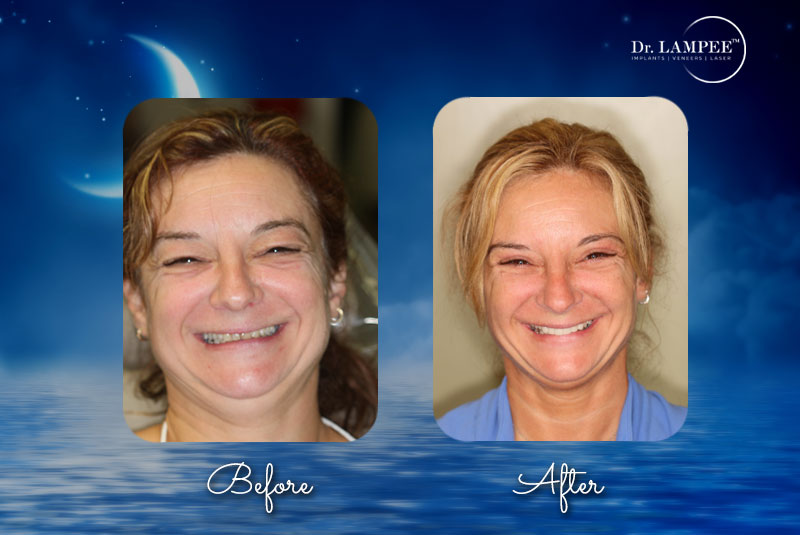 ana maria veneers before and after