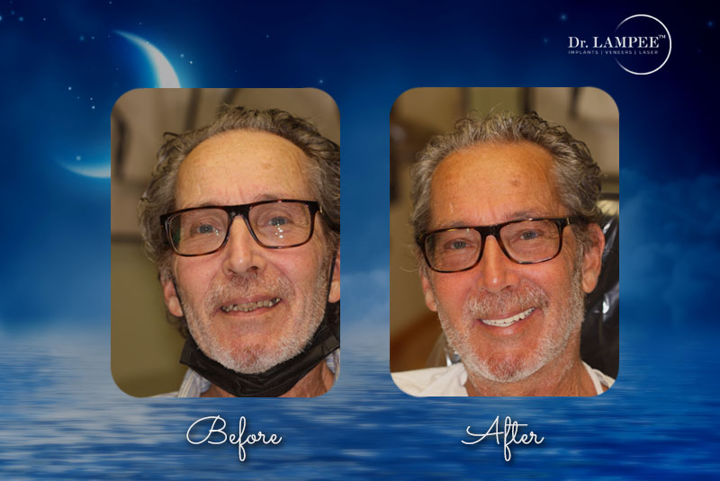 bob teeth in a day before and after