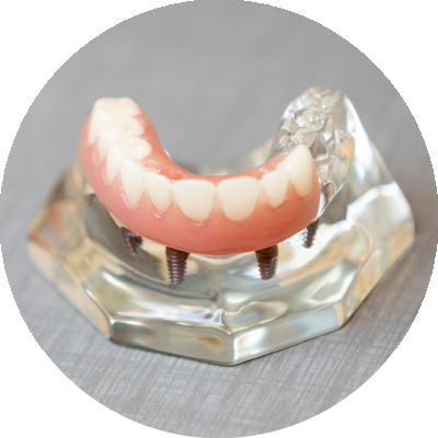 full arch dental implant_model placed on counter
